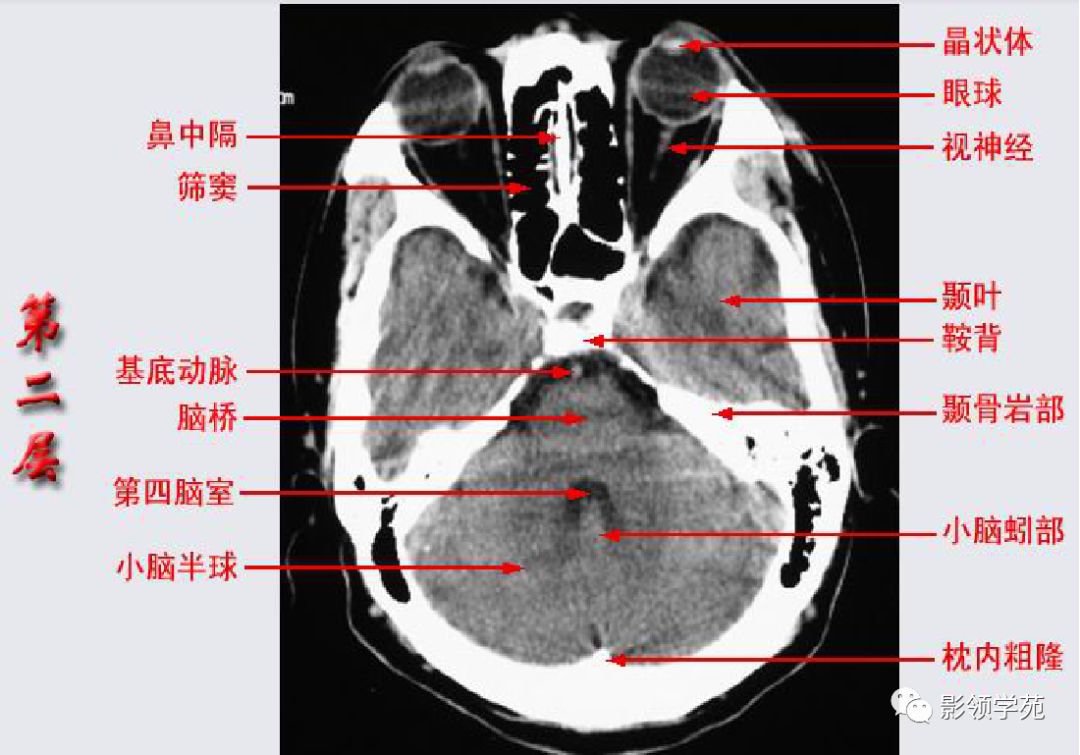 基底节区ct图谱图片