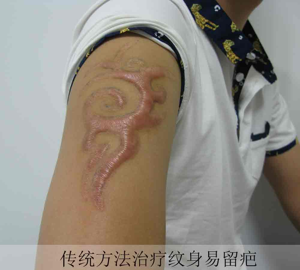 上海长江胎记医院如何才能去除纹身呢