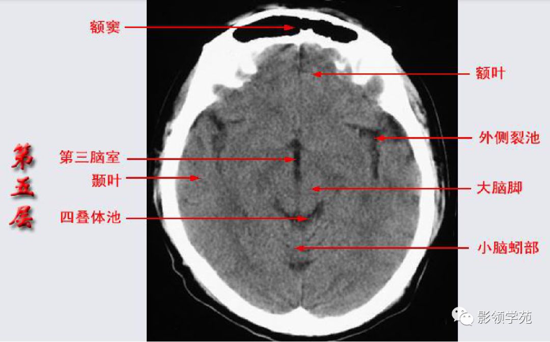 脑的ct解剖结构图图片