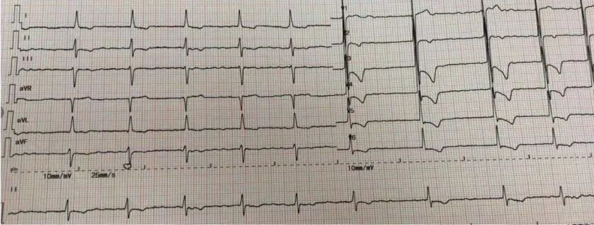 慢性心衰心电图表现图片