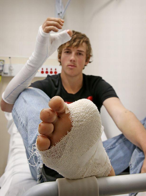 母牛踢飞男子的拇指,医生移植大脚趾当大拇指