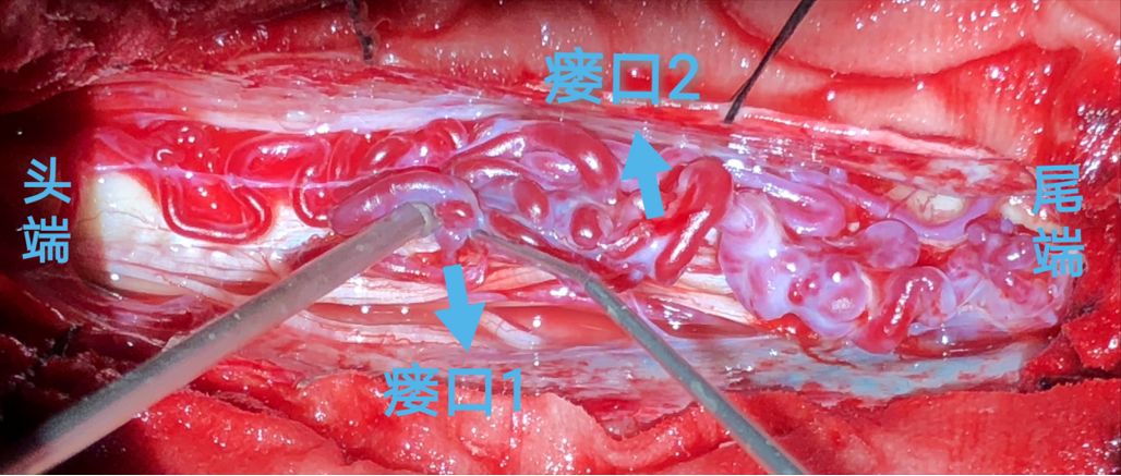 髓周动静脉瘘手术图片