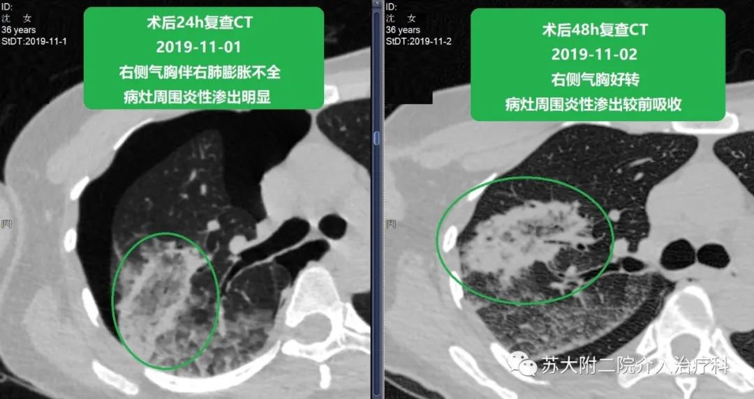 靳勇2019-10-30行ct示右肺上葉一亞實性結節影,約7mm×8mm,於2019-10