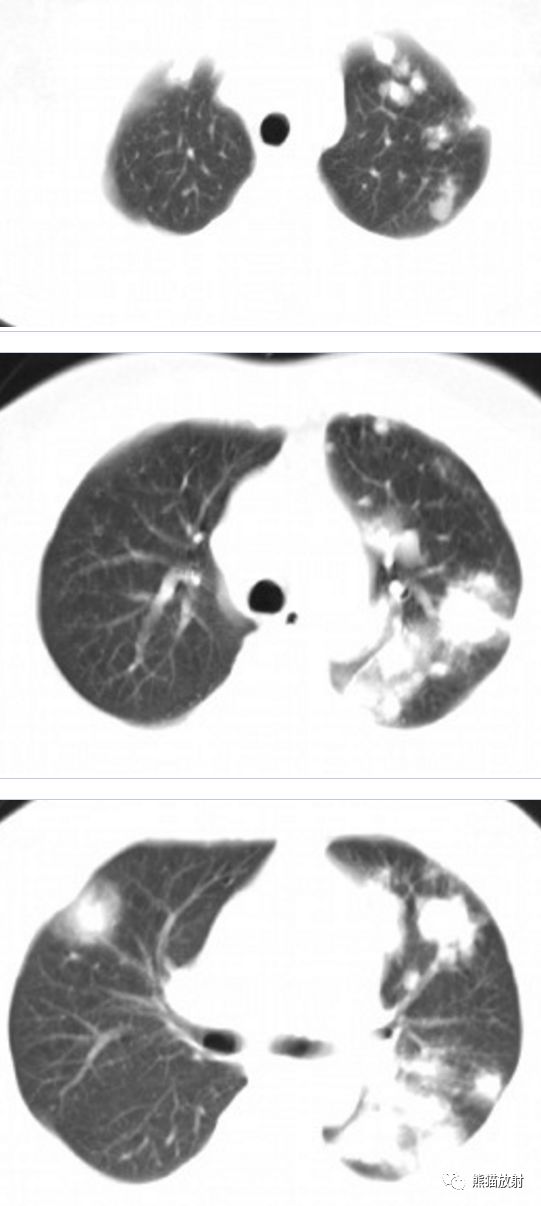 多发肺结节之肺隐球菌病丨小打卡读片精选36