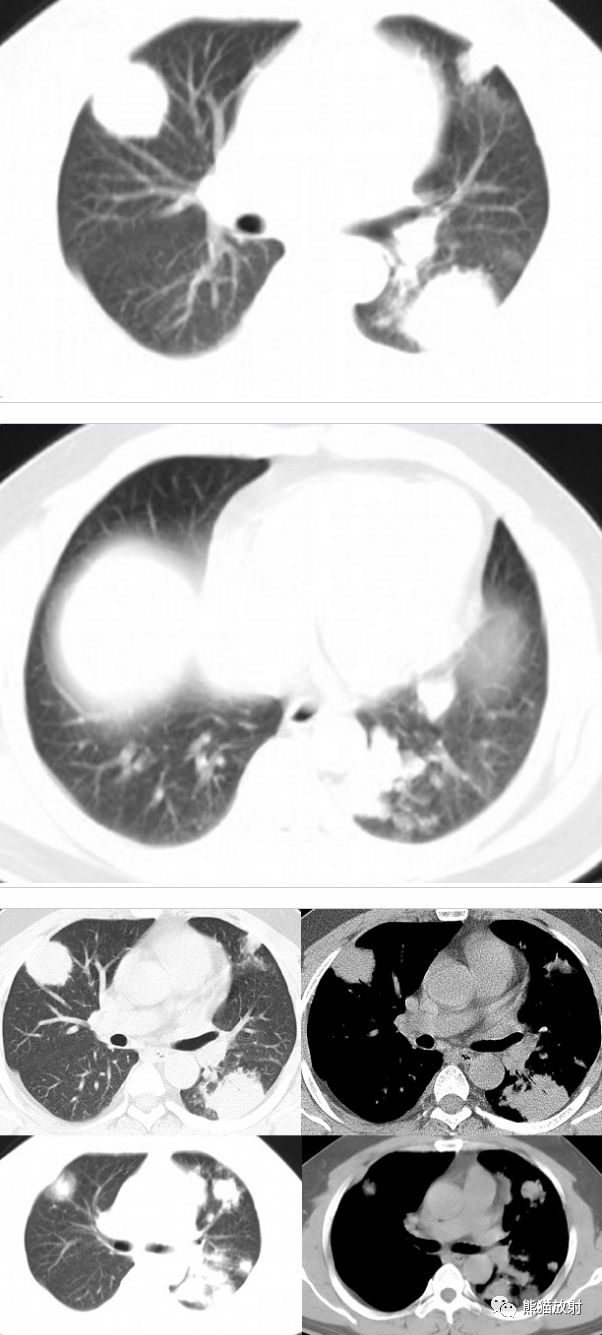 多发肺结节之肺隐球菌病丨小打卡读片精选36