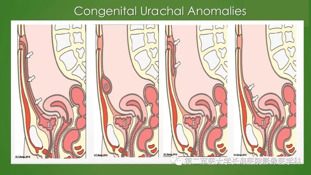脐尿管位置图详细图片