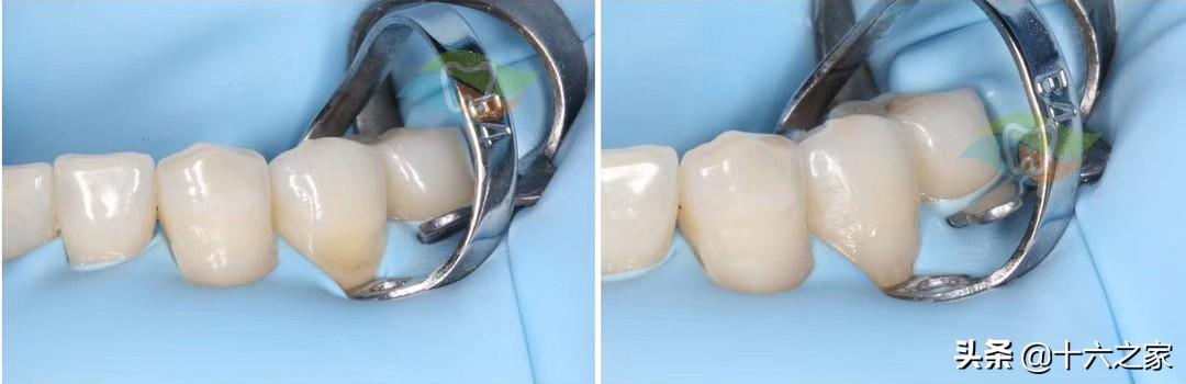 楔状缺损修复病例