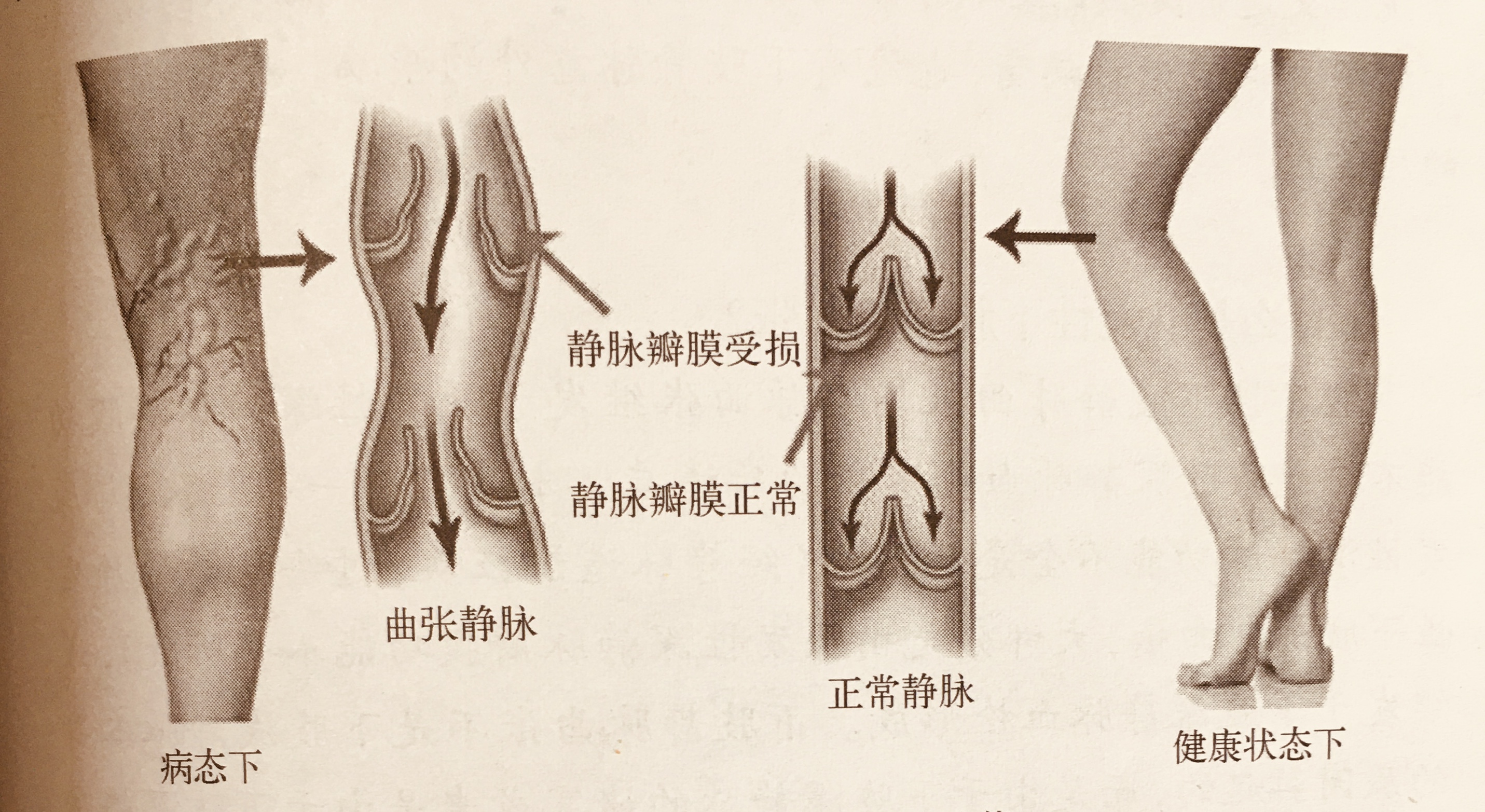 静脉瓣膜示意图图片