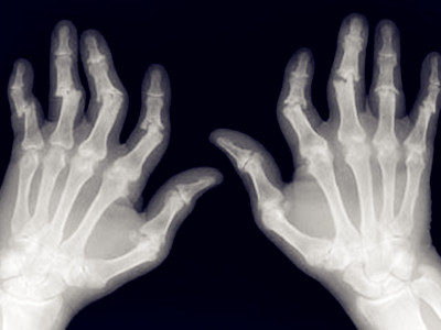 关节肿痛要警惕是类风湿性关节炎