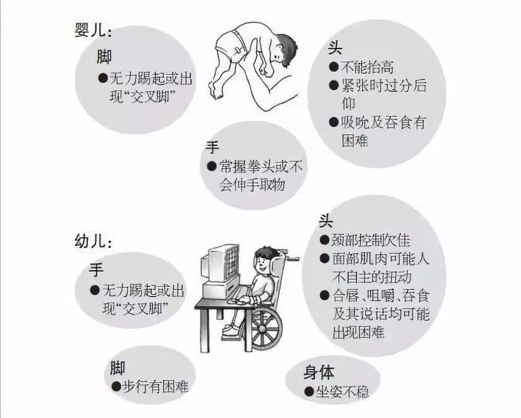 6脑性瘫痪有什么成因?※研究显示每1000个儿童中,约有2个患有脑麻痹