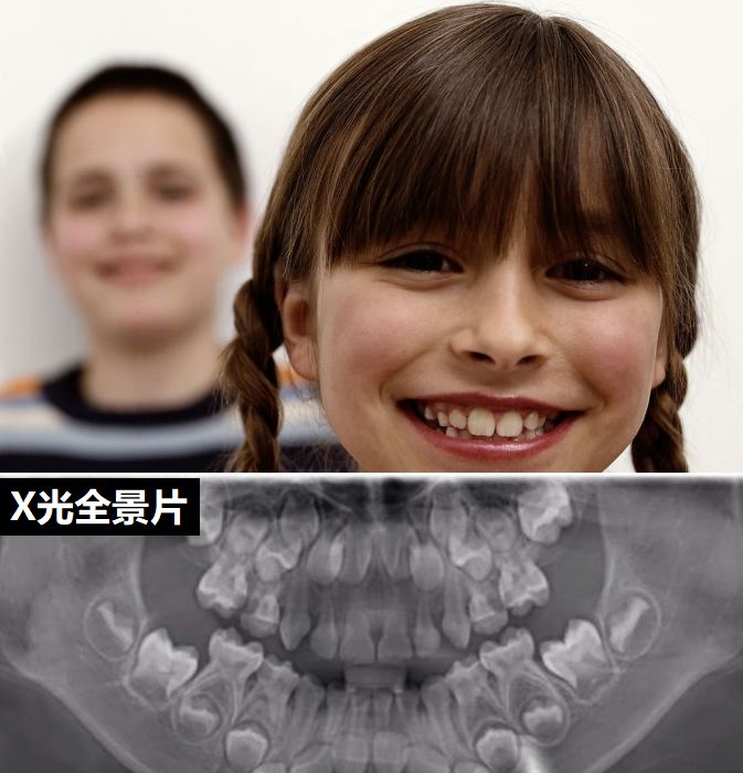 小孩牙齿x光图图片