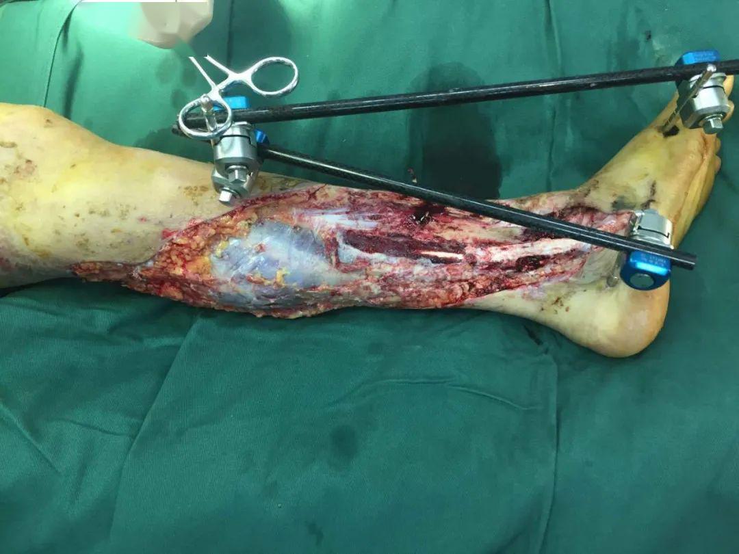 大腿截肢手术图片真实图片