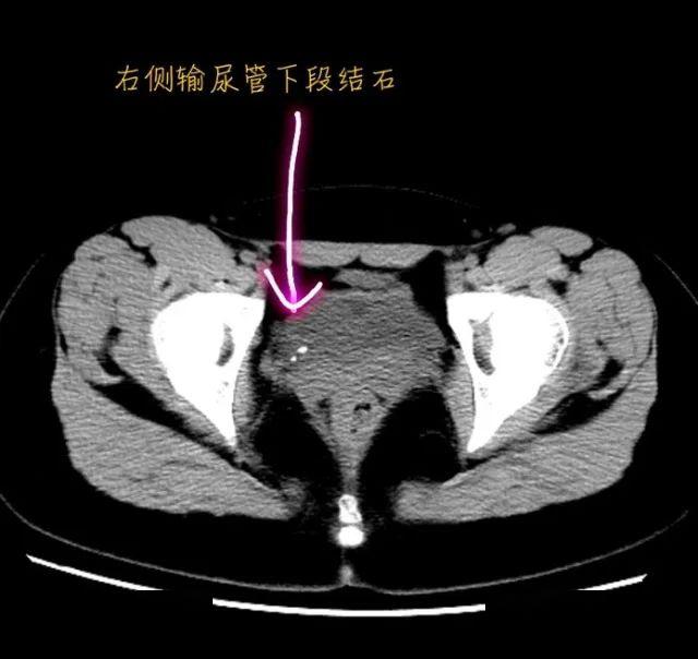 输尿管在ct的走行图图片