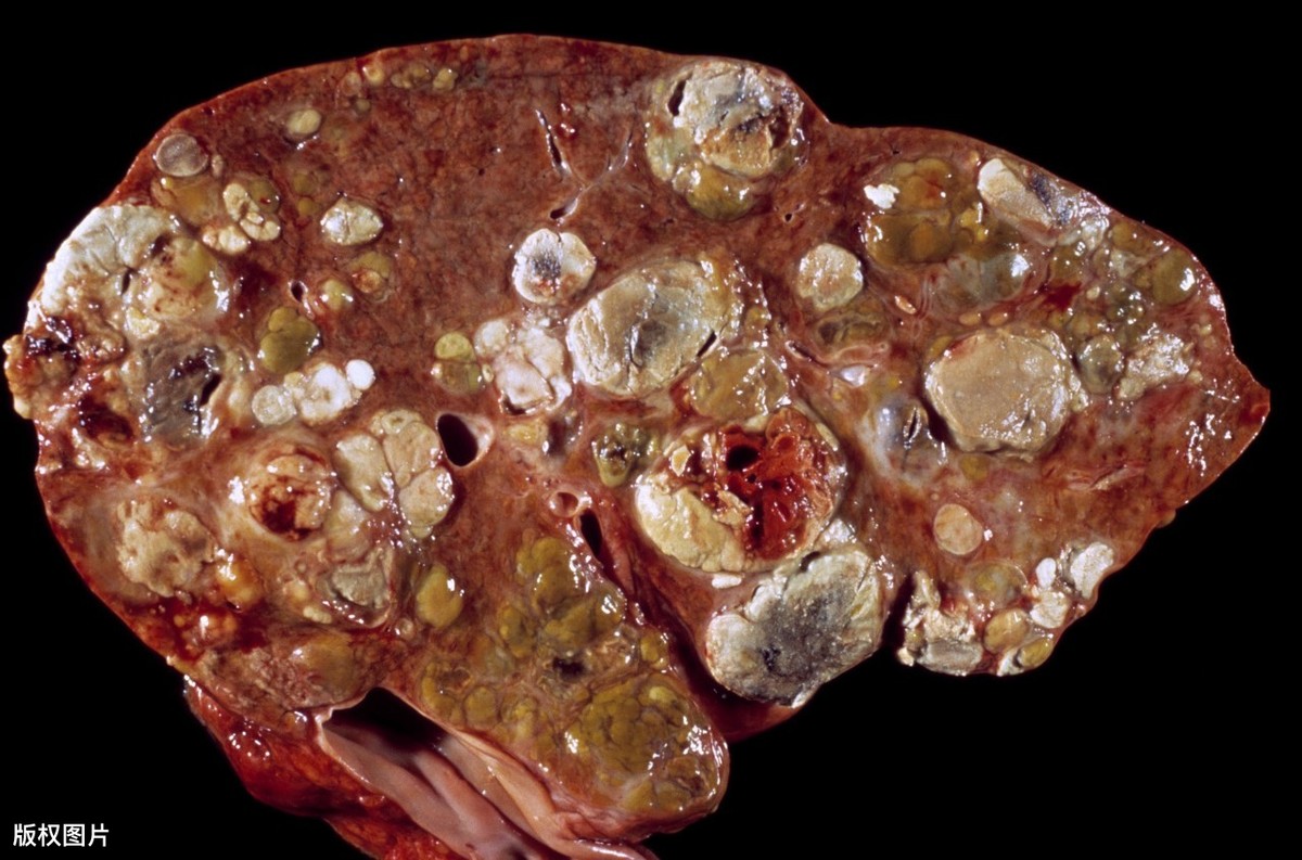 肝癌病人的肝脏图片图片