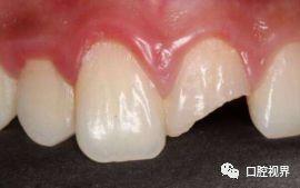 门牙意外折断不要慌!如何治疗看这里!_牙髓