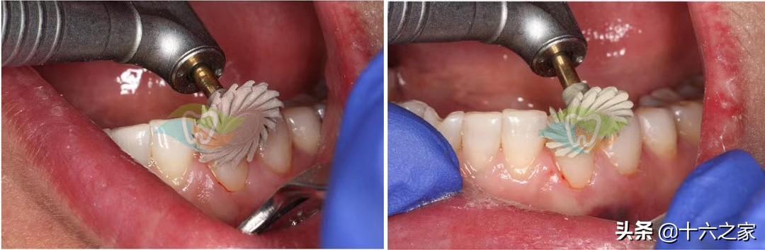 楔状缺损修复病例