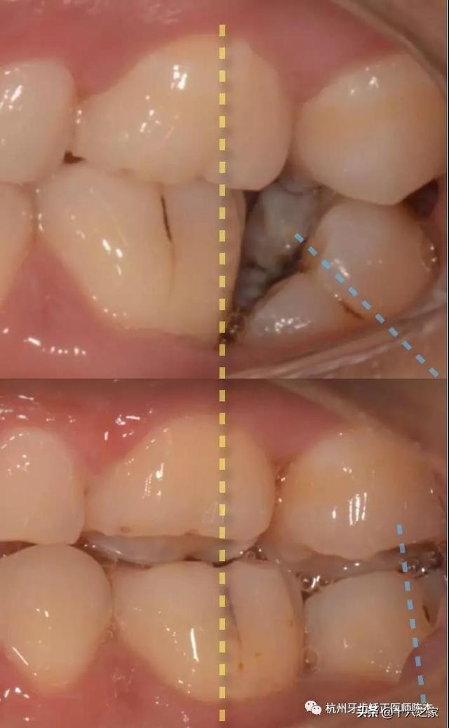 正畸临床病例三高效竖直倾斜磨牙的2种方法