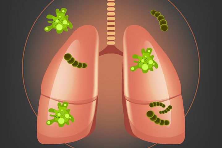 原創乾貨病毒性肺炎與細菌性肺炎有哪些區別疫情當下你應懂區分