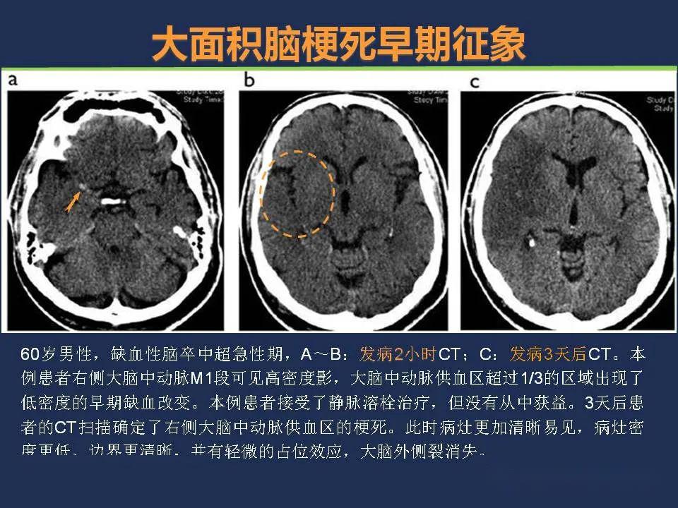 脑梗塞ct表现图片图片