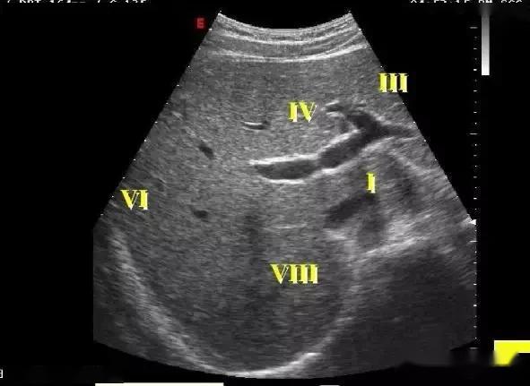 肝脏分段解剖图超声图片