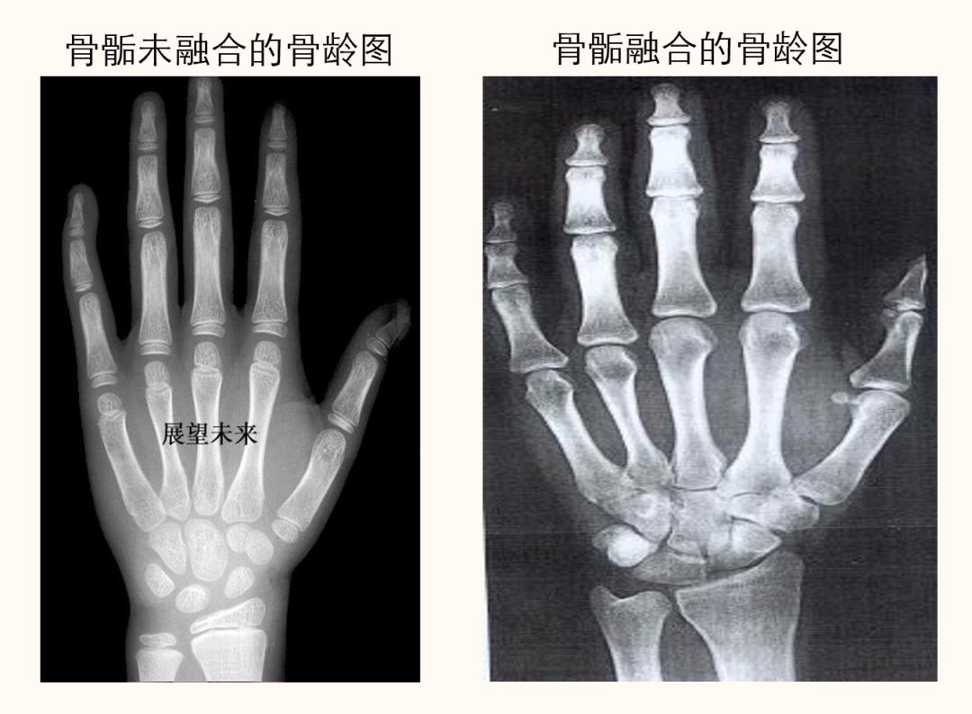 骨骼的发育贯穿于整个生长发育过程,是评估剩余生长潜力的有效依据