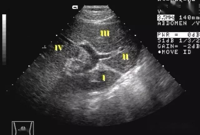 肝脏分段解剖图超声图片