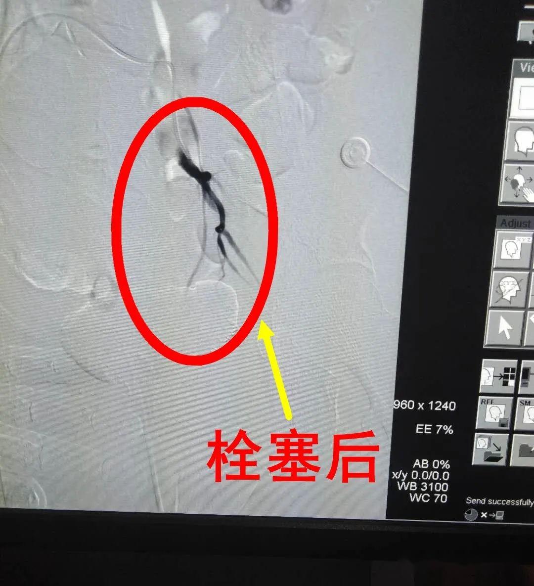 突破治療下消化道出血的新手段消化道動脈造影及栓塞術