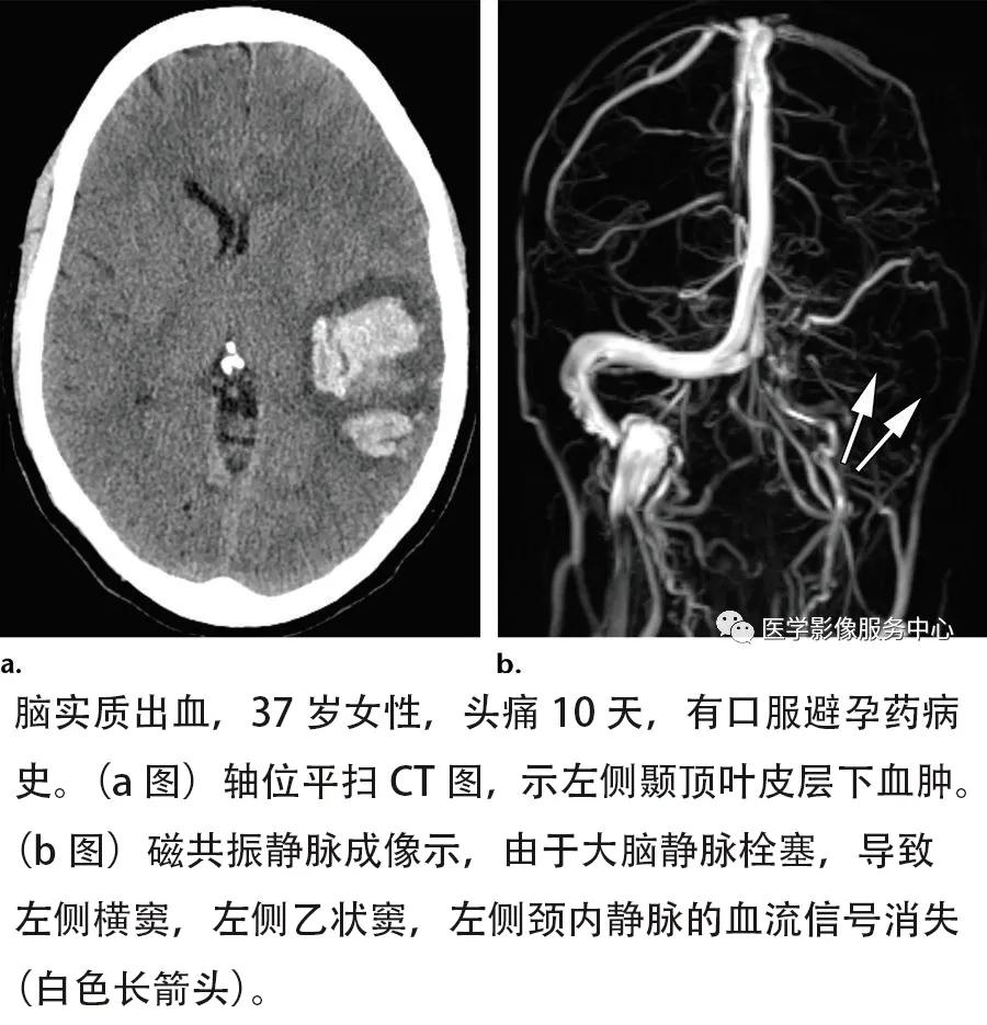 脑静脉mrv正常报告模板图片