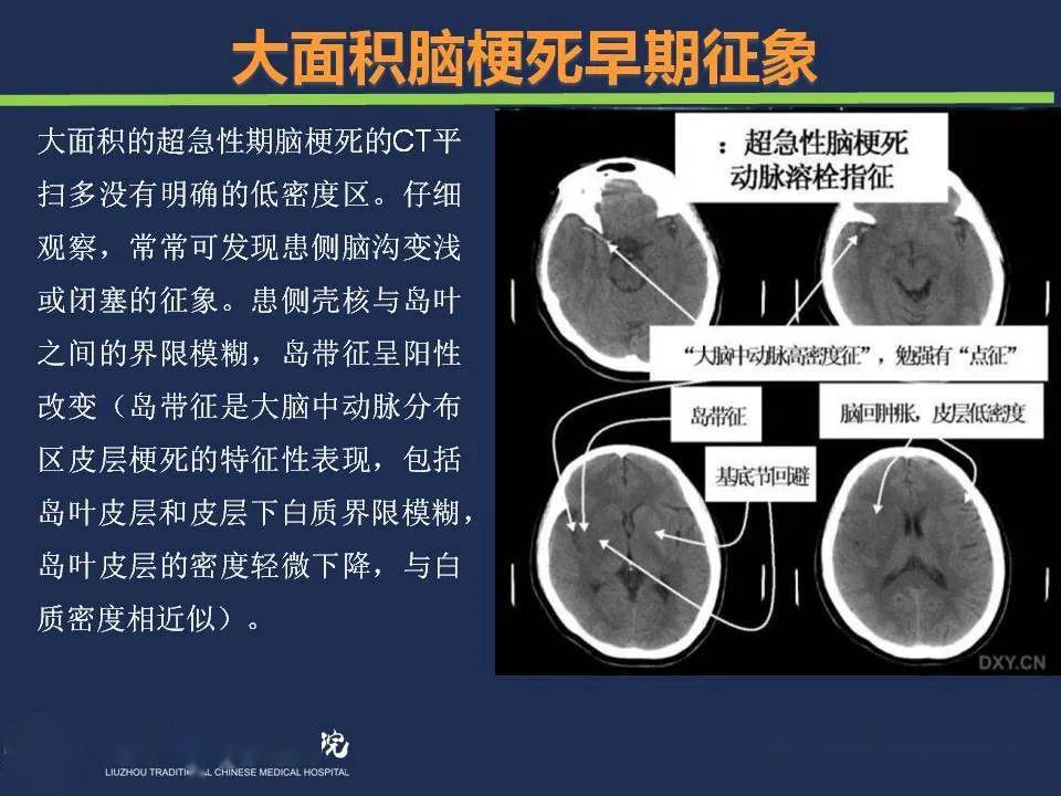 脑梗塞ct图片解读图片