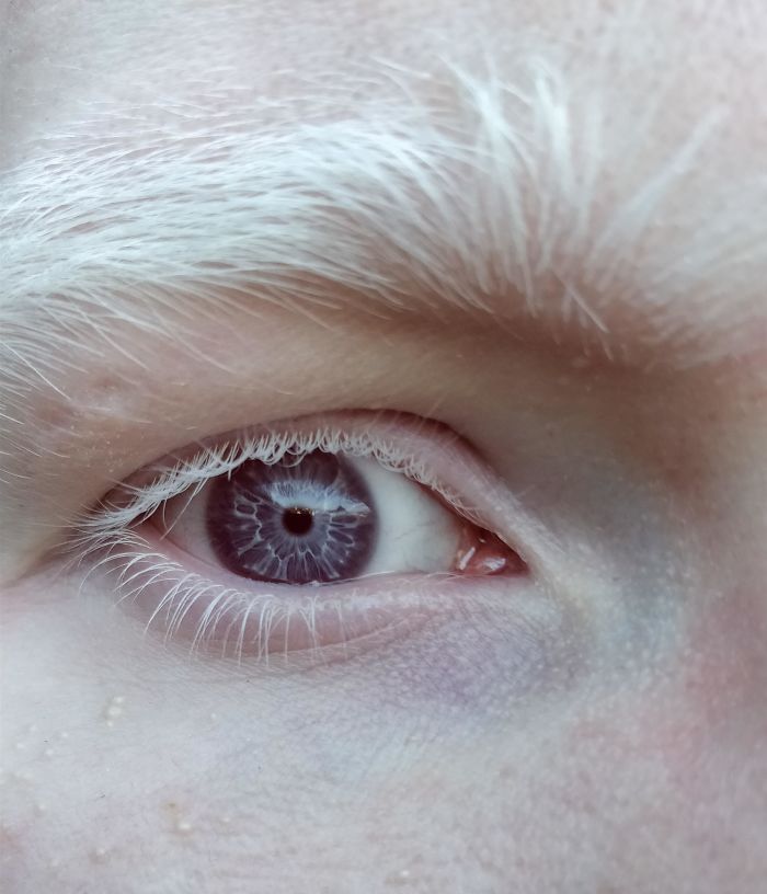 白化病的眼睛图片