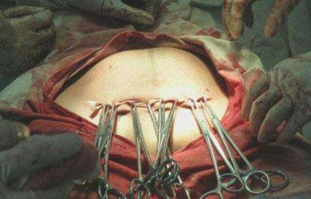 剖腹产横切还是竖切好资深产科主任透露真相几句话言明区别