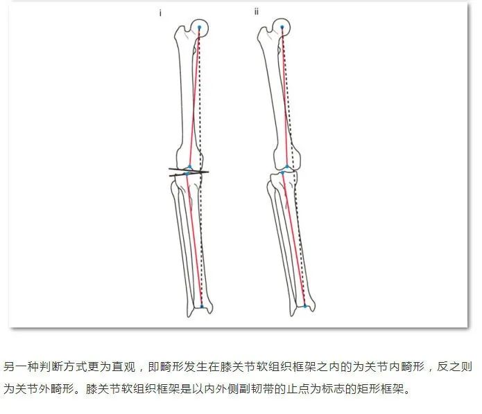 如何评估膝关节关节外畸形
