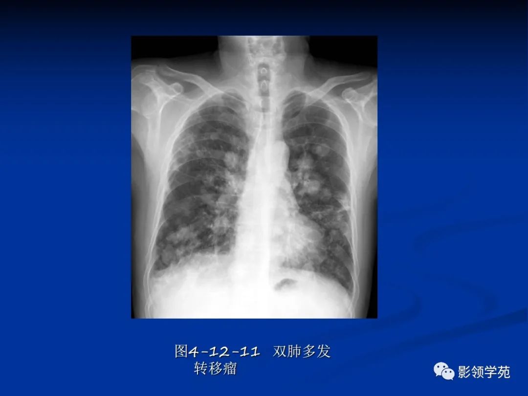 肺肿瘤影像学汇总