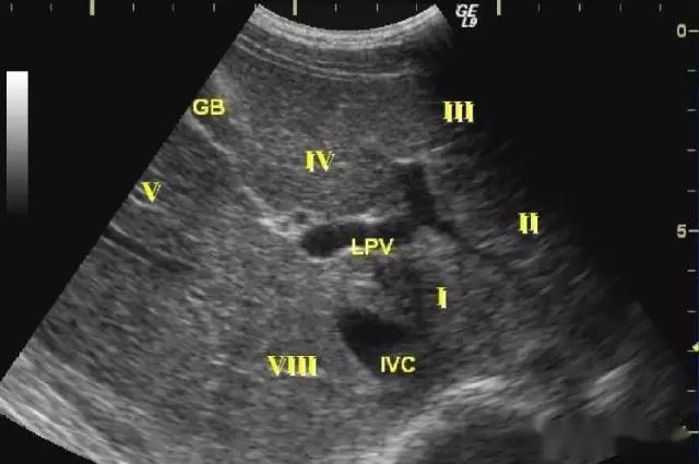 超声肝脏8分段法图谱图片