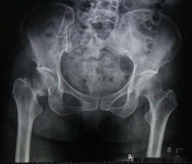 股骨颈骨折骨不连会得股骨头坏死吗该怎么办