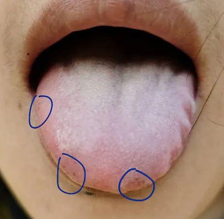舌头上有血瘀图片图片