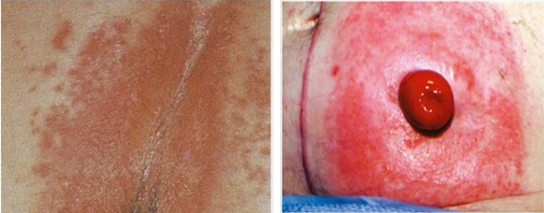 造口周围皮肤常见并发症–特征原因和治疗