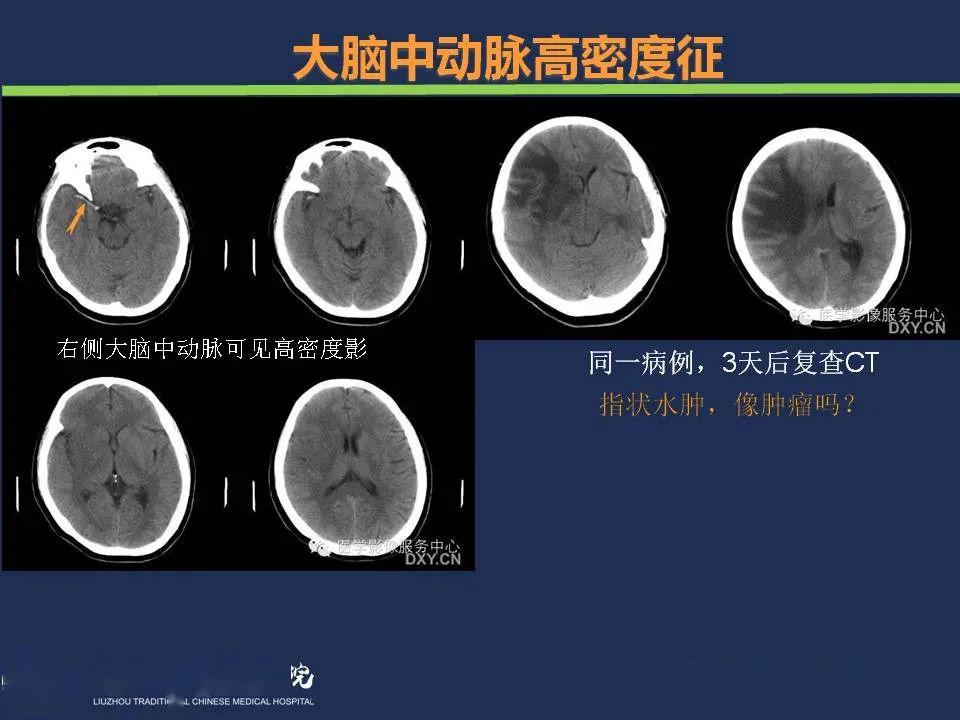 脑梗ct图片解说图图片