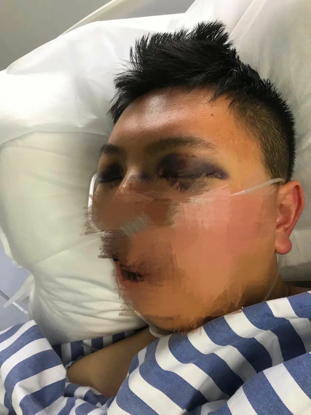 气溶胶感染!警惕流行性出血热(汉坦病毒)!没想到竟然是另一种病!