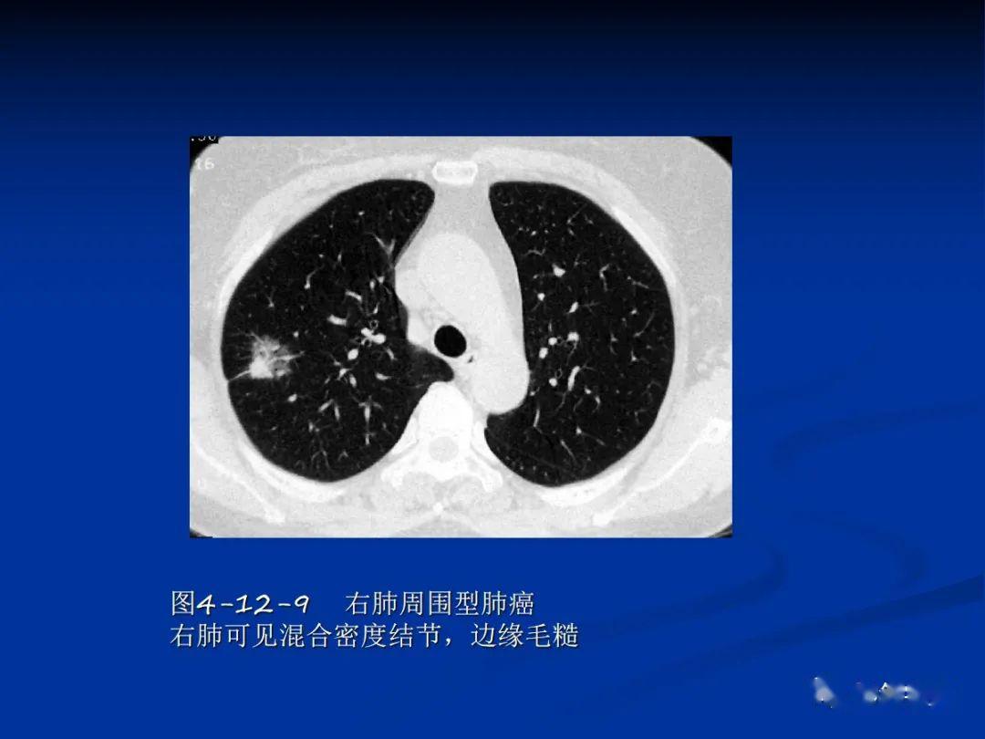 肺肿瘤影像学汇总