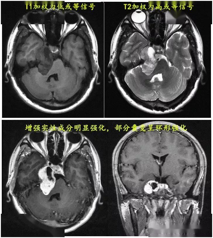 三叉神经瘤影像表现与鉴别诊断