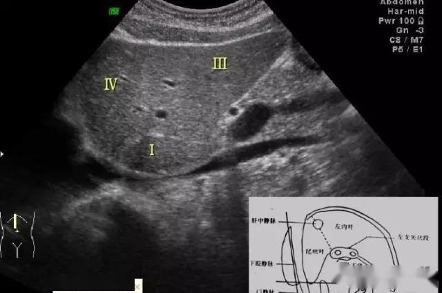 腹部超声实用肝脏分叶分段及超声对比图