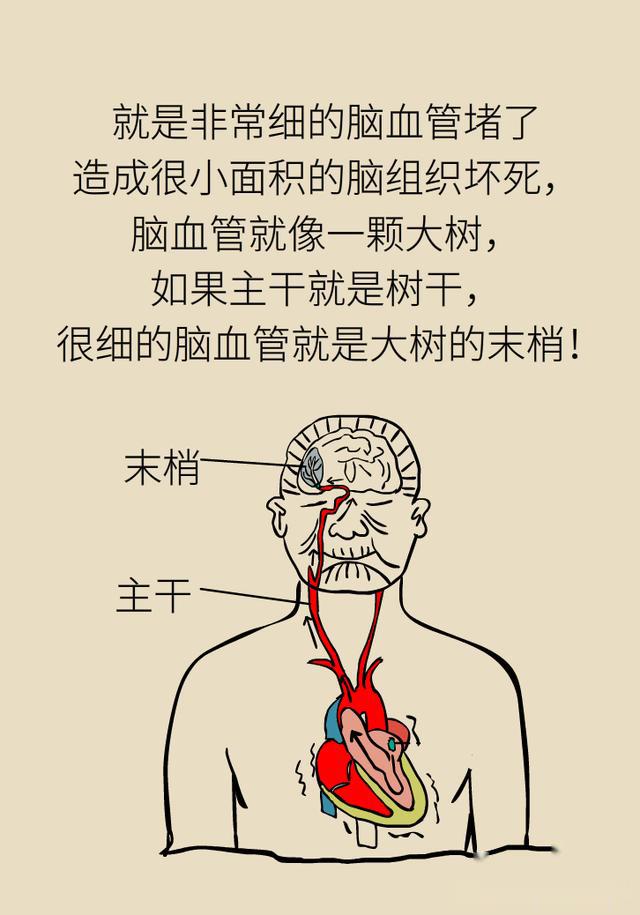 脑梗会死吗图片