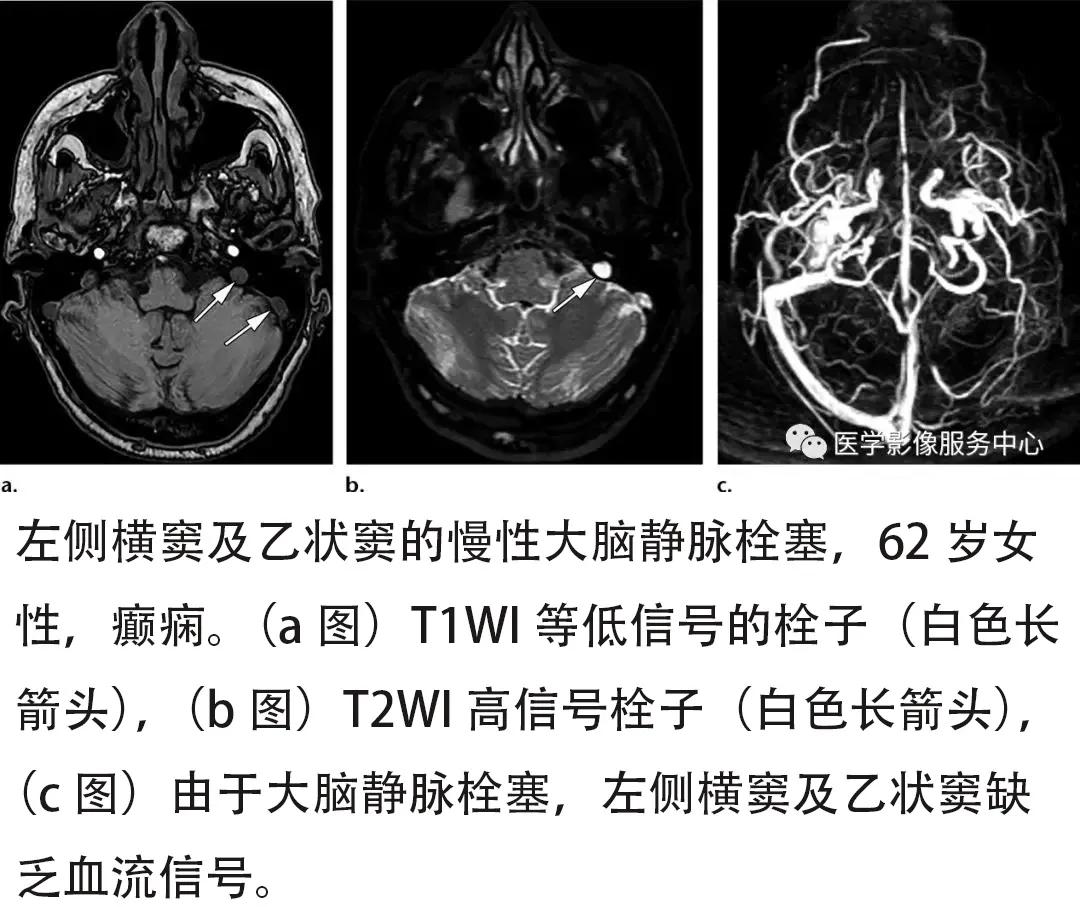 神经影像大脑静脉栓塞的影像学征象