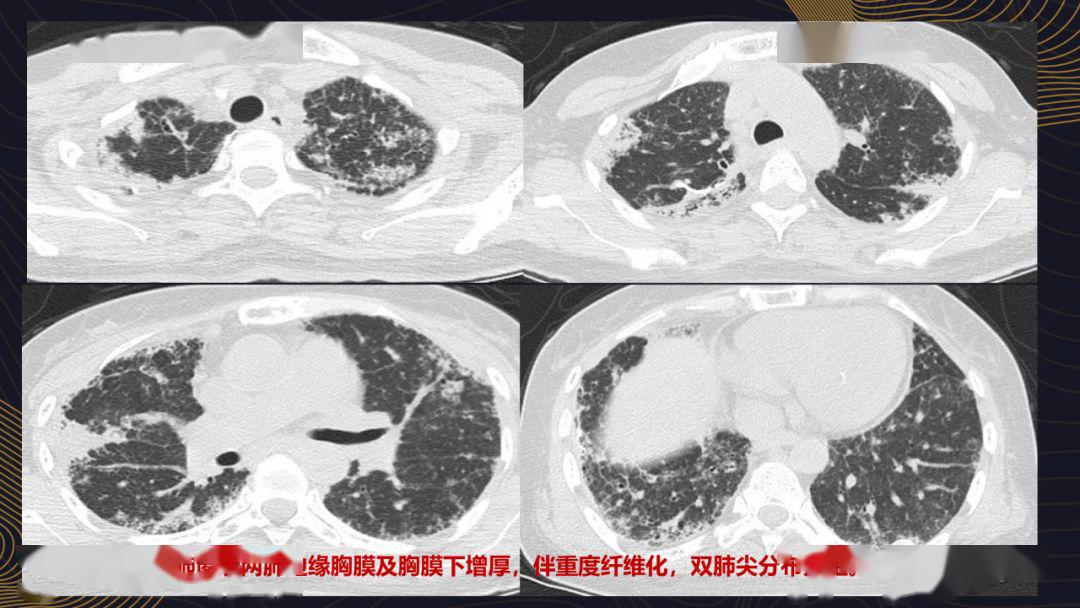 实例探讨:胸膜肺实质弹力纤维增生症