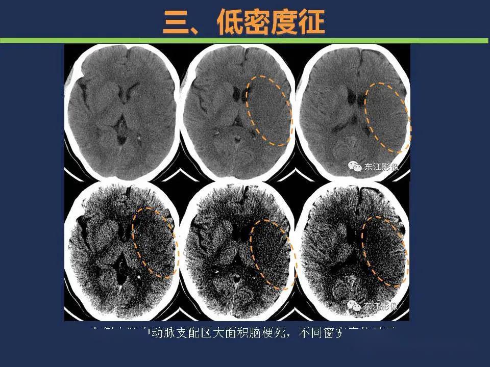 脑梗塞ct图片解读图片