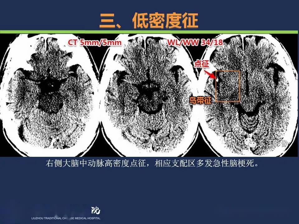 脑梗ct图片解说图图片