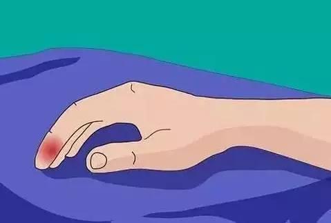 打球老吃鱼蛋手指戳伤如何处理