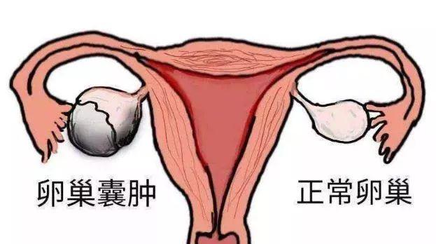 4,卵巢囊肿卵巢囊肿也会导致女性不孕,可以干扰卵巢激素的正常分泌和