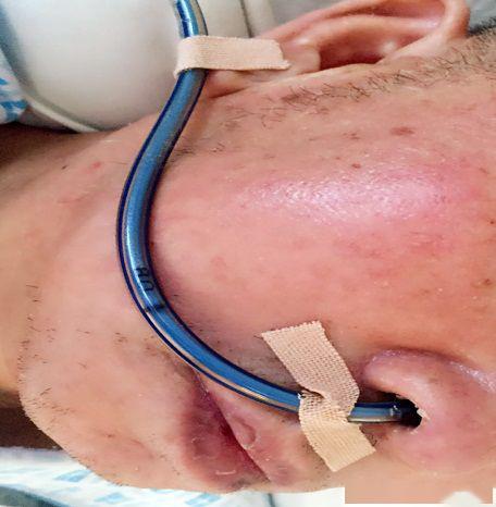 胃管留置你真的掌握了吗